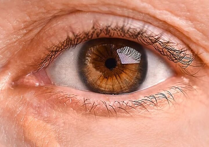 Gelbe Flecken an den Augen: Warnzeichen für Herz- und Gefäßrisiken