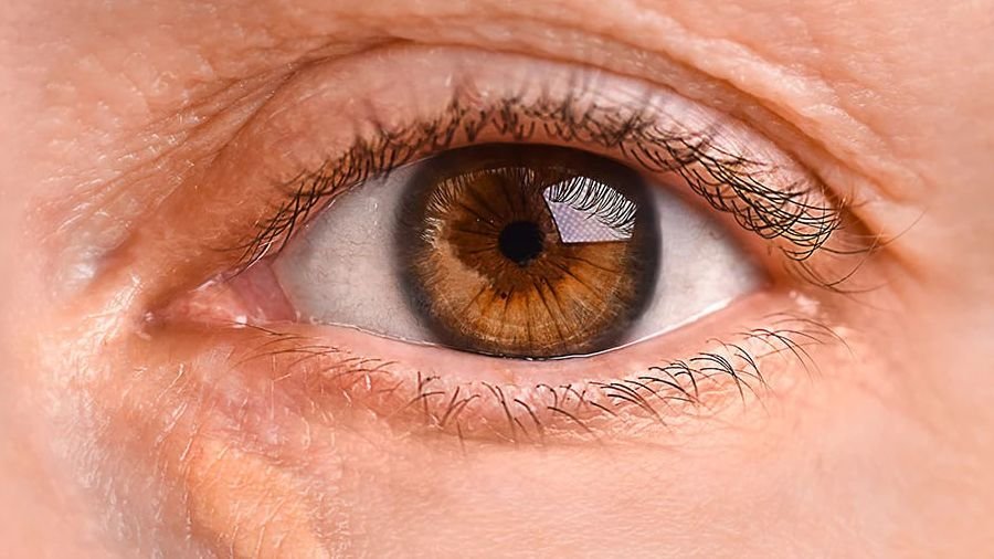 Gelbe Flecken an den Augen: Warnzeichen für Herz- und Gefäßrisiken